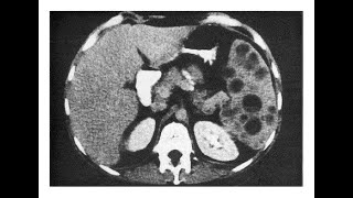 Pneumocystis carinii Abszesse in der Milz [upl. by Hodess566]