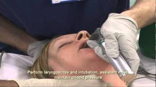 Intubation Extubation 37 [upl. by Lanam]