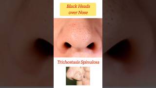 Black Heads amp Hairs over Nose  Trichostasis Spinulosa noseblackheads nosehair blackheads nose [upl. by Rugg70]