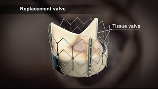 TAVI Transcatheter Aortic Valve Implantation [upl. by Burkley238]