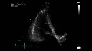 Carcinoid Syndrome [upl. by Brear]