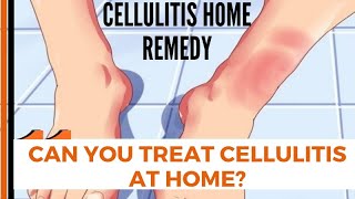 Can You Treat Cellulitis at Home  cellulitis home remedy [upl. by Getraer77]