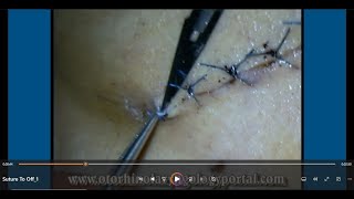 Suture To Off Removal of Sutures [upl. by Hnib889]