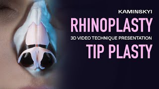 POLYGON CONCEPT TIP PLASTY PRESERVATION RHINOPLASTY  KAMINSKYI [upl. by Yasnil]