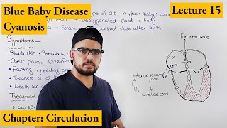 Cyanosis  Blue baby  Cardiovascular disorders  Chapter Circulation video 15 [upl. by Genna]