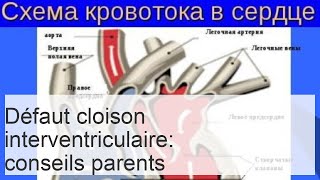 Défaut septum interventriculaire  malformation cardiaque congénitale non fatale [upl. by Nilyram]