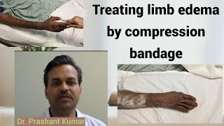 Treating limb edema by compression bandage [upl. by Shepard109]