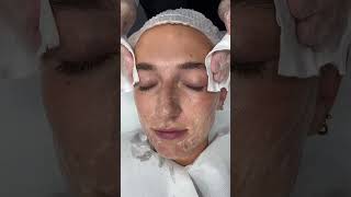 Benefits of Mandelic Acid Skin Peels  Dr Medispa [upl. by Marozik606]