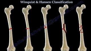 Fractures Of The Femur Shaft Winquist amp Hansen  Everything You Need To Know  Dr Nabil Ebraheim [upl. by Yblocaj]