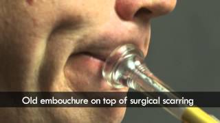 Trumpet embouchure before and after surgery [upl. by Louls507]