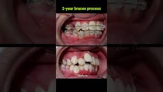 Braces evolution  2 years braces orthodontist dentist [upl. by Ballinger]