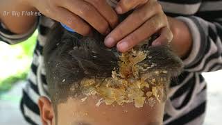 Dandruff Scratching Giant Flake  Big Flakes Itchy Dry Scalp In Lazy Boys Hair 106 [upl. by Arul]