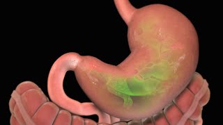 Stomach Ulcer  Nucleus Health [upl. by Aniar]