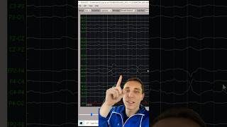 Sharp Discharges on EEG After Hemorrhagic Stroke [upl. by Rattray]