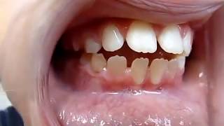 Tongue Thrust Video Myofunctional Therapist [upl. by Berkley]