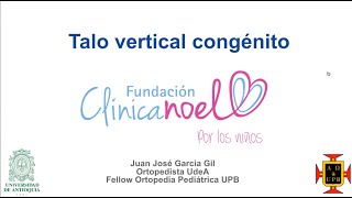 Talo Vertical Congénito [upl. by Bois]