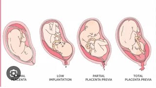 How to manage antepartum haemorrhage🚨😷drsaminakhurshidgynaecolog4661 [upl. by Aleda]