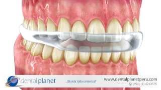 Bruxismo  Férula de Relajación Muscular  DENTAL PLANET PERÚ [upl. by Robins]