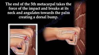 Boxers Fracture  Everything You Need To Know  Dr Nabil Ebraheim [upl. by An]