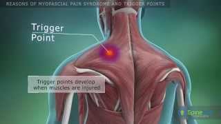 Myofascial pain syndrome and trigger points Reasons [upl. by Nnylaj755]