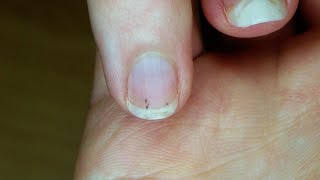 The Basics How to Remove a Splinter  WebMD [upl. by Gualterio]