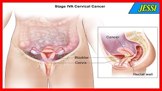 Cervical Biopsy Overview  Common Gyn Problems [upl. by Bathelda]