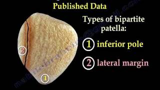 Bipartite Patella  Everything You Need To Know  Dr Nabil Ebraheim [upl. by Aneehsor528]