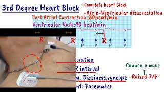 AV Heart Block  First degree heart Block  Mobitz type1  Mobitz type2  Complete heart Block [upl. by Ecnarretal]