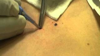 Microdermal Dermal Anchor Removal at MediZen Cosmetic Clinic Birmingham UK [upl. by Phyllis]