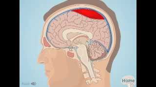 Subdural Hematoma [upl. by Rochkind]