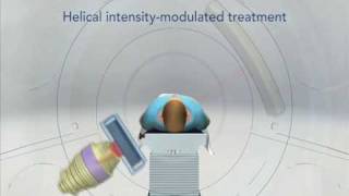 TomoTherapy  Revolutionary Radiation Therapy [upl. by Vijar]