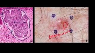 Introduction to NMSC Skin Cancer 2 Basal Cell Cancer BCC and Squamous Cell Cancer SCC [upl. by Chadwick]