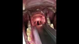 Laryngeal paralysis oral exam [upl. by Papotto]