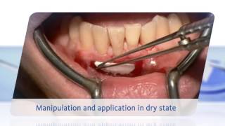 Geistlich Mucograft® Handling Video [upl. by Caren866]