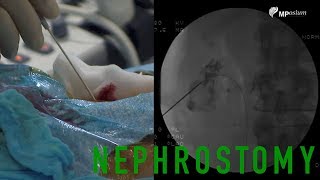 Bilateral Nephrostomy performed by Prof Thierry DeBaere [upl. by Aseek901]