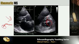 Lecture 11  Mitral Valve Part 1 [upl. by Dael91]