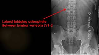 case 604 Lateral bridging osteophyte [upl. by Clark687]