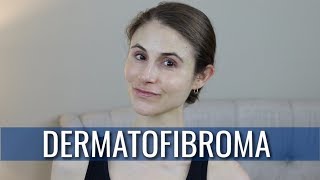 DERMATOFIBROMA WHAT IS IT HOW IS IT TREATED  DR DRAY [upl. by Netsrak93]