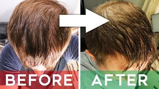 Finasteride Review  Does It Cure Hair Loss  Finasteride Before and After 8 months [upl. by Colette]