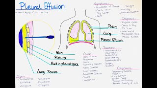 Understanding Pleural Effusion  Causes Symptoms Diagnosis Treatment Complications Types [upl. by Notsur]