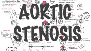 Aortic Stenosis  Overview signs and symptoms pathophysiology treatment [upl. by Holleran]