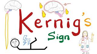 Kernig Sign  Meningitis  Neurology Physical Exam [upl. by Minna985]