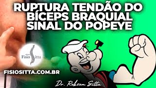 LESÃO RUPTURA TENDÃO CABO LONGO do BÍCEPS BRAQUIAL SINAL do POPEYE Fisioterapia Dr Robson Sitta [upl. by Cathleen806]