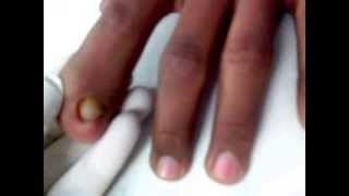 Index Finger Deformity  Brachydactyly  Flat index finger । तर्जनी अंगुली का आगे से चौडा होना [upl. by Noreh927]