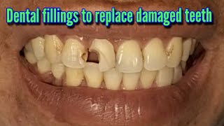 Dental fillings to replace damaged teeth [upl. by Standley]