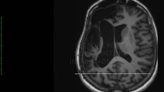 Post Stroke Gait and Postural Disturbances [upl. by Harley]