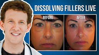 Dissolving Under Eye Fillers  Live Procedure [upl. by Sosthina]