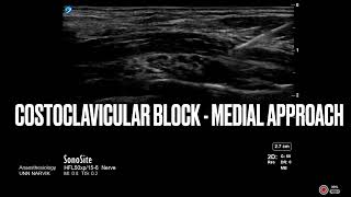 Costoclavicular block  medial approach  Regional anesthesia ultrasound regionalanesthesia [upl. by Centonze]