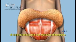 Abdominoplastia [upl. by Blackman]