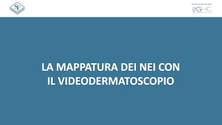 La mappatura dei nei con il videodermatoscopio [upl. by Violet]